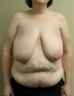 Breast Reduction