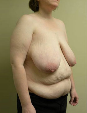 Breast Reduction Case 5956 Before Photo Breast Reduction