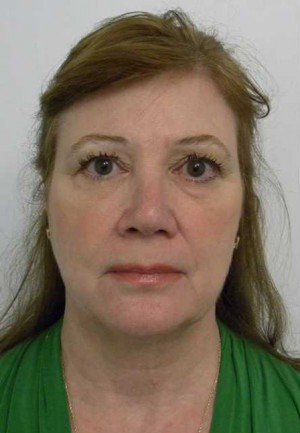 Facelift Case 6149 Before Photo Facelift