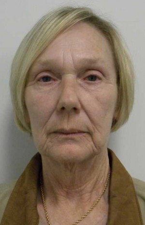 Facelift Case 6164 Before Photo Facelift