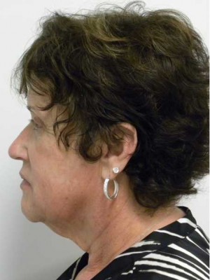 Facelift Case 6167 Before Photo Facelift