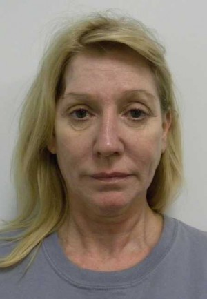 Facelift Case 6189 Before Photo Facelift