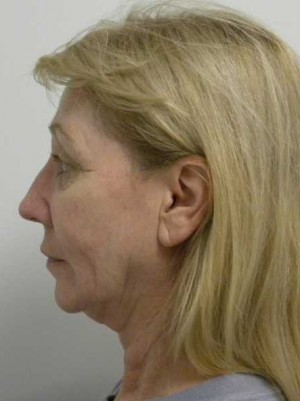 Facelift Case 6189 Before Photo Facelift