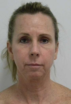 Facelift Case 6194 Before Photo Facelift