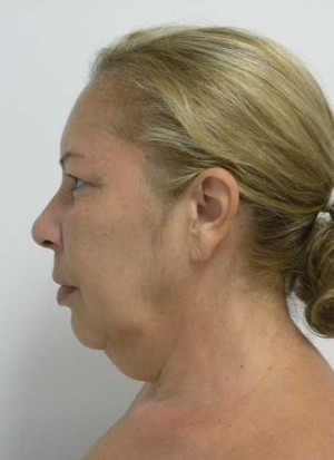 Facelift Case 6199 Before Photo Facelift