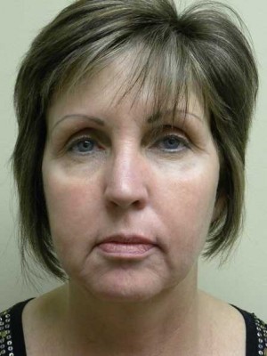 Facelift Case 6209 Before Photo Facelift