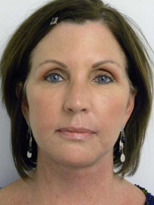 Facelift Case 6209 After Photo Facelift