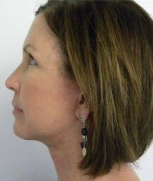 Facelift Case 6209 After Photo Facelift