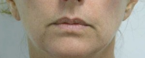 Valentine lip lift Case 6225 Before Photo Valentine lip lift