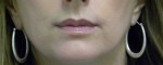 Valentine lip lift