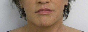 Valentine lip lift Case 6228 After Photo Valentine lip lift