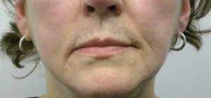 Valentine lip lift Case 6234 Before Photo Valentine lip lift