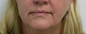 Valentine lip lift Case 6237 Before Photo Valentine lip lift