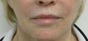 Valentine lip lift Case 6246 Before Photo Valentine lip lift
