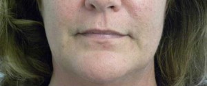 Valentine lip lift Case 6249 Before Photo Valentine lip lift