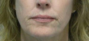 Valentine lip lift Case 6252 Before Photo Valentine lip lift