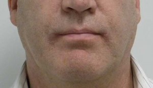 Valentine lip lift Case 6258 After Photo Valentine lip lift