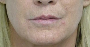 Valentine lip lift Case 6261 Before Photo Valentine lip lift