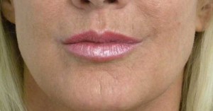 Valentine lip lift Case 6261 After Photo Valentine lip lift