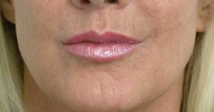 Valentine lip lift