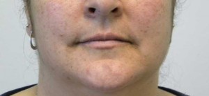 Valentine lip lift Case 6264 Before Photo Valentine lip lift