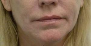 Valentine lip lift