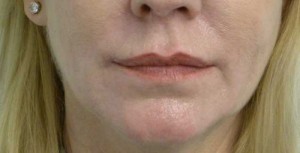 Valentine lip lift