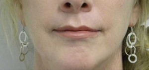 Valentine lip lift Case 6279 After Photo Valentine lip lift