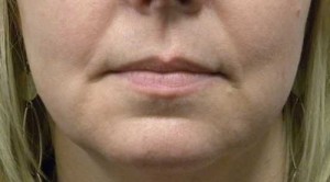 Valentine lip lift Case 6282 Before Photo Valentine lip lift