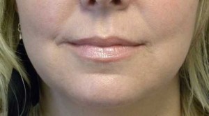 Valentine lip lift Case 6282 After Photo Valentine lip lift