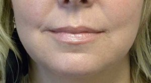 Valentine lip lift