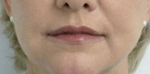 Valentine lip lift Case 6285 After Photo Valentine lip lift
