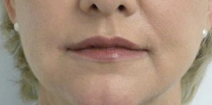 Valentine lip lift