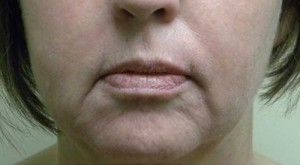 Valentine lip lift Case 6291 Before Photo Valentine lip lift