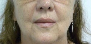 Valentine lip lift Case 6294 After Photo Valentine lip lift