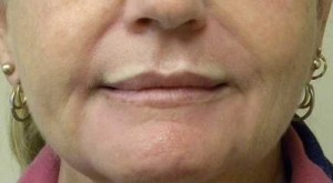 Valentine lip lift Case 6297 After Photo Valentine lip lift