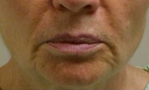 Valentine lip lift