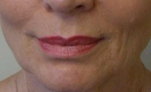 Valentine lip lift