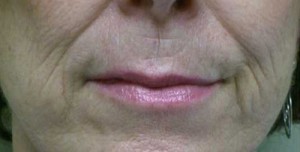 Valentine lip lift Case 6303 Before Photo Valentine lip lift