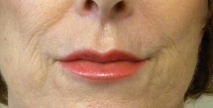 Valentine lip lift Case 6303 After Photo Valentine lip lift