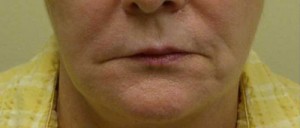 Valentine lip lift Case 6306 Before Photo Valentine lip lift