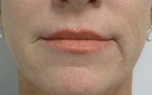 Valentine lip lift Case 6309 After Photo Valentine lip lift