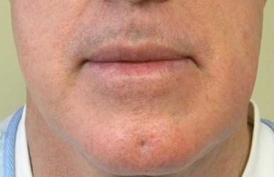 Valentine lip lift Case 6312 Before Photo Valentine lip lift
