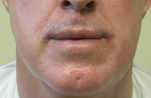 Valentine lip lift Case 6312 After Photo Valentine lip lift