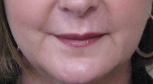 Valentine lip lift Case 6315 After Photo Valentine lip lift
