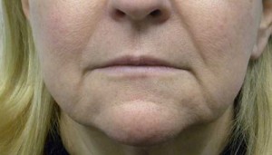 Valentine lip lift Case 6318 Before Photo Valentine lip lift