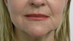 Valentine lip lift