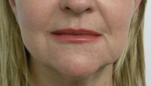 Valentine lip lift Case 6318 After Photo Valentine lip lift
