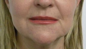 Valentine lip lift