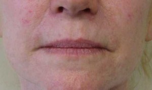 Valentine lip lift Case 6321 Before Photo Valentine lip lift